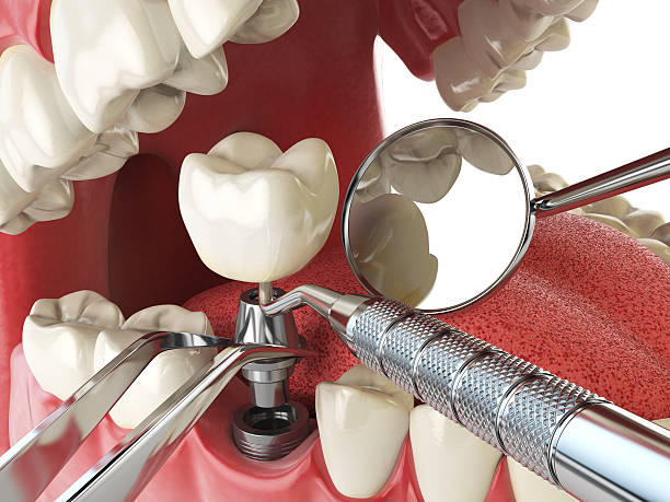 Best Emergency Wisdom Teeth Removal in Meiners Oaks, CA